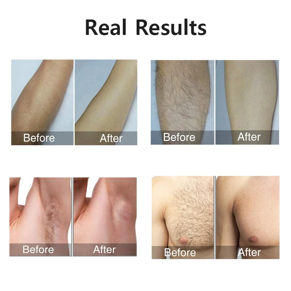 IPL Laser Hair Removal Device 990000 Flashes